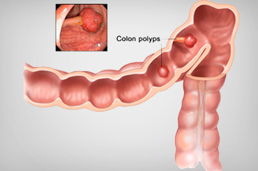 Colon cancer