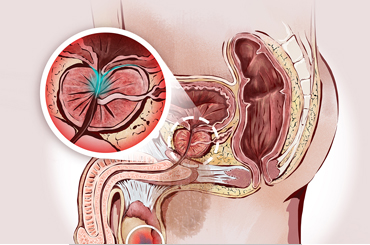 Prostate cancer