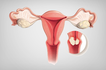 Cervical cancer