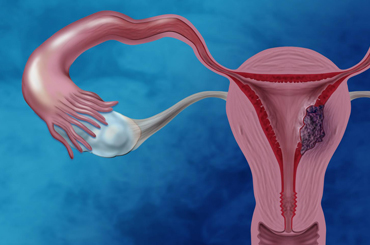 Uterine  cancer