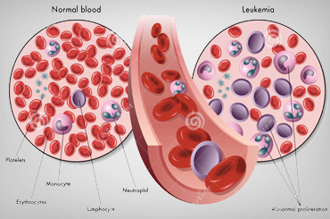 Leukemia Blood cancer