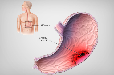 Stomach cancer