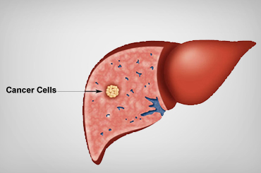 Liver cancer