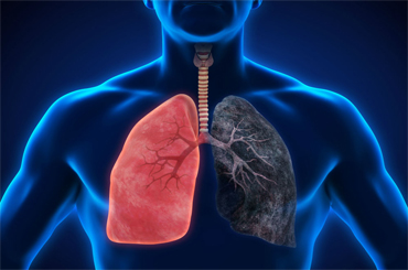 Lung cancer