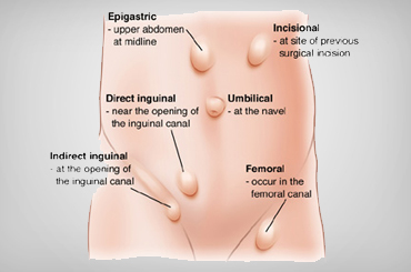 Prostate cancer