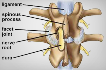 Uterine  cancer