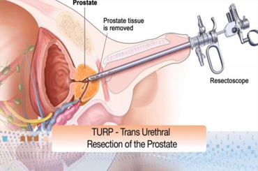 Oral cancer