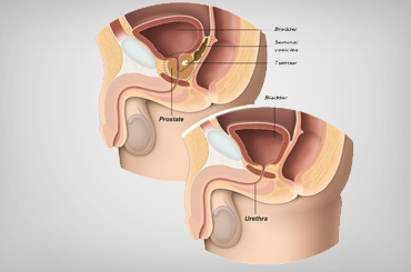 Prostate cancer