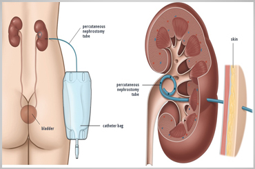 Cervical cancer