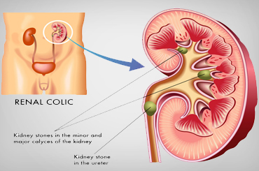 Uterine  cancer